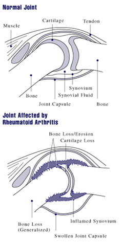 Rheumatoid Arthritis